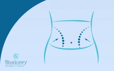 عملية شد البطن