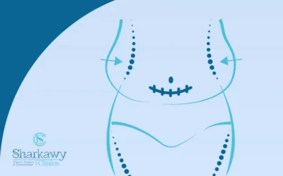 عملية شد البطن بعد الولادة القيصرية