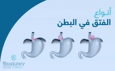 انواع الفتق في البطن