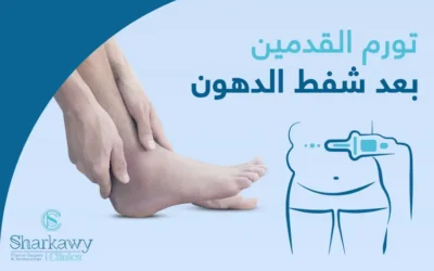 تورم القدمين بعد عملية شفط الدهون