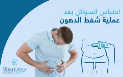 احتباس السوائل بعد عملية شفط الدهون.. الأسباب والعلاج