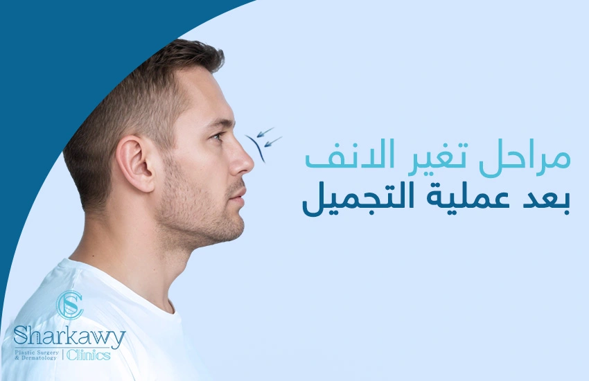 مراحل تغير الانف بعد عملية التجميل مراحل تغير الانف بعد عملية التجميل