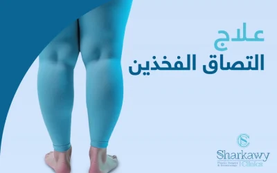 علاج التصاق الفخذين لبدء حياة أكثر نشاطًا وراحة